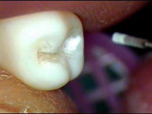Class II MOD preparation - mandibular second premolar