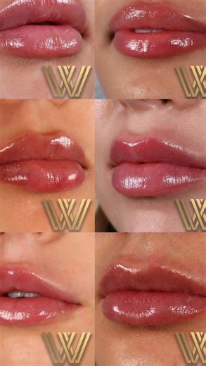 Best Orlando Injectors | The Princess Injectors® on Instagram: "Want lip hydration, more definition , symmetry improvements, increased volume or enhanced lips then you want our Signature MK Pout performed only by a certified Princess Injector 👑👑👑👑👑 #Orlando #naturallips #orlandolips"