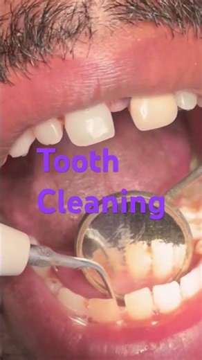 Tooth scaling #tooth cleaning #tooth whitening
