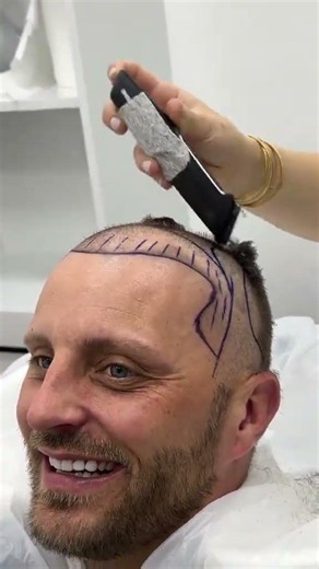 The Hair Transplant Everyone's Talking About #hairtransplant #transformation #beforeandafter
