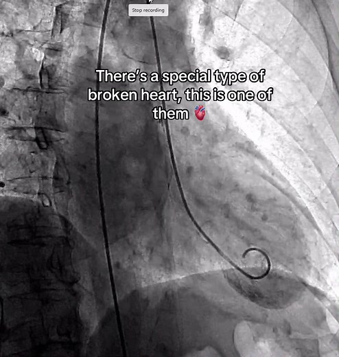 Understanding Broken Hearts: A Medical Perspective