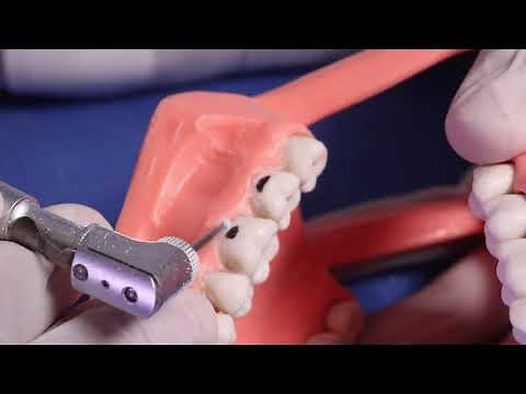 Preparación y técnica para la realización de cavidades clase V