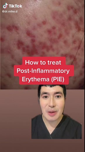 Effective Remedies for Post-Inflammatory Erythema (PIE) Treatment