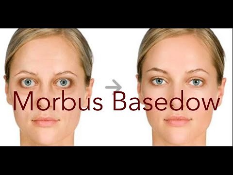 Der Morbus Basedow