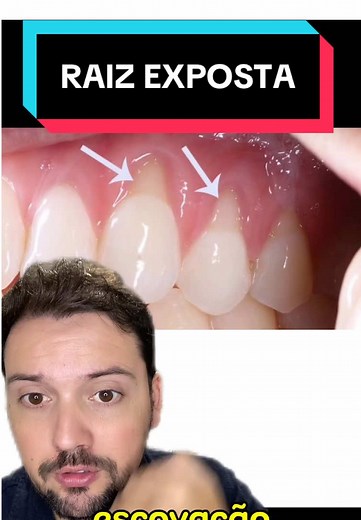Raiz do Dente Exposta: Causas e Tratamentos