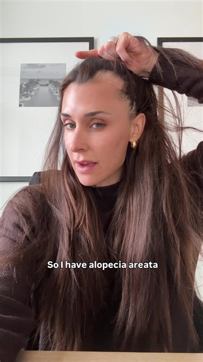 Good news / bad news update 🤍 The bad news: I was diagnosed with alopecia areata. The good news: With the right treatment my hair has a high chance of growing back. Here’s the simple version of what’s happening and how my derm explained it to me: Normally, your hair follicles are “immune privileged,” meaning your immune system leaves them alone. With alopecia areata, that protection gets switched off. My immune system basically mistook my hair follicles for a threat and attacked them, which is 