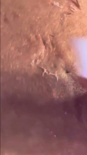 Extractions | Blackheads | NILUFER ESTHETICS SPA #esthetician #estheticianlife #acnetreatment #skin