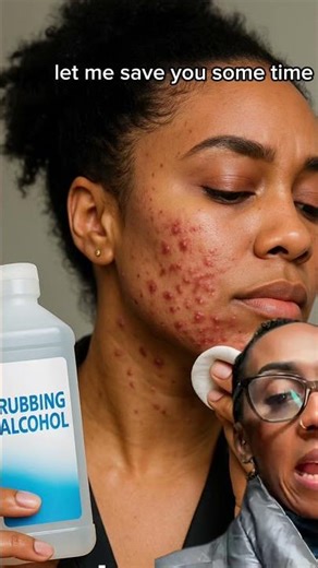 Jawline Acne = Hormonal | Stop the DIY Hacks