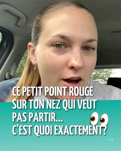 Dr Marie Jourdan on Instagram: "👉Vous avez déjà vu ce petit point rouge sur le nez qui ne veut pas disparaître ? On pourrait croire que c’est un bouton… mais ce ne l’est pas. ⭐️C’est un angiome stellaire (spider angioma in English ☕️). Une lésion vasculaire bénigne et fréquente. #Dermato #SpiderAngioma #AngiomeStellaire #Peau #Skincare"