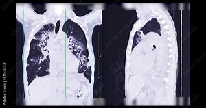 CT Scan of Chest or Lung for diagnosis lung diseases.