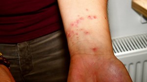 Tique, punaise, araignée ou moustique ? Comment identifier l’insecte ou autre "petite bête" qui nous a piqués