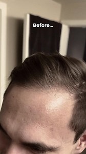 Watch this incredible transformation as our friend discovers the power of Hairmax's FDA-cleared laser technology. The LaserBand 82 combined with Density shampoos doesn't just change hair—it changes confidence. #BeforeAndAfter #ConfidenceBoost #Hairmax #HairThinning | Hairmax | Facebook