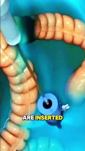 Appendix Removal Surgery (3D Animation)#AppendixRemoval #Appendicitis #GeneralSurgery #Medical3D