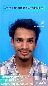 #burn #hairtransplant #shortvideo #cosmeticsurgery #bestresults