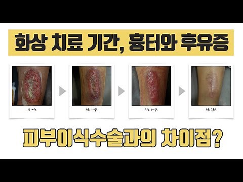 화상치료 FAQ 2탄_화상 치료 기간, 흉터와 후유증, 피부이식수술과 한의원 치료의 차이점