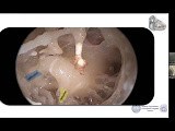 Round Window Anatomy and Endoscopic Assisted Cochlear Implant • Video • MEDtube.net