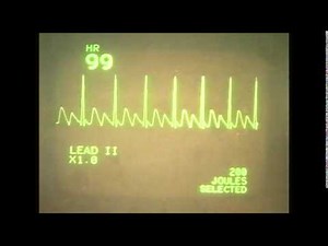 EKG (ECG) rhythms 3, Abnormal atrial rhythms