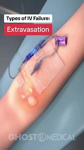 10K views · 44 reactions | Intravenous (IV) therapy can encounter...