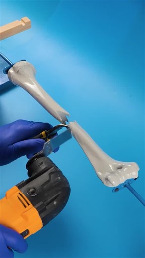 Ideas en 5 minutos on Instagram: "¿Cómo funciona la cirugía de crecimiento? 🦴 #medicina #traumatología #ciencia"