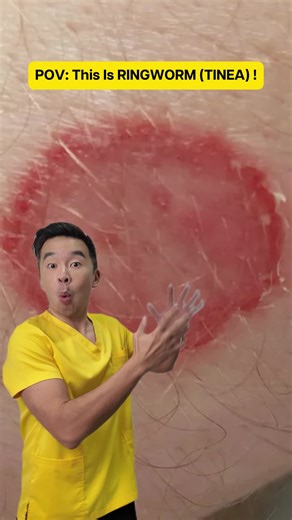 Understanding Ringworm: Causes and Effective Treatments