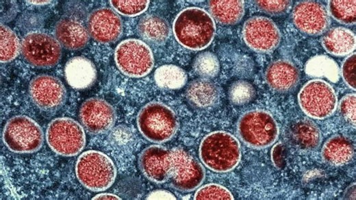 Over half of mpox patients from 2022 outbreak reported ongoing symptoms