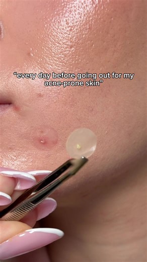 What will happen to an acne patch after 5 hours? #skincaretips #acneprone #acneproneskin #pimple #makeuphacks