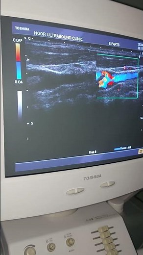 carotid bulb.. carotid Artery Doppler ultrasound