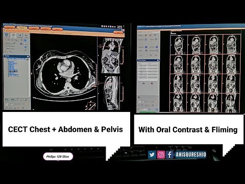 CECT Chest + Abdomen & Pelvis with Oral Contrast and Fliming| By Anis Qureshi