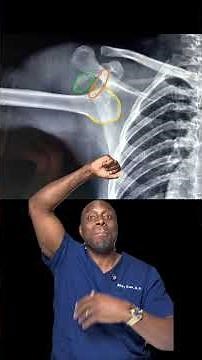 Shoulder Dislocation: Luxatio Erecta