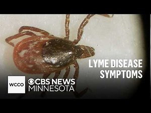 Woman with chronic Lyme disease shares misdiagnosis story | Talking Points