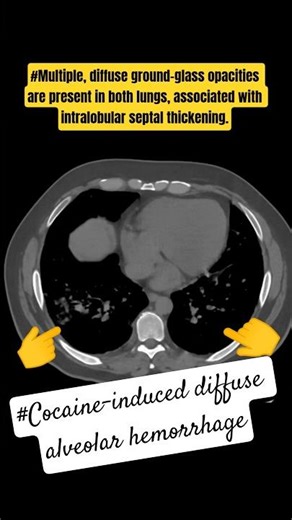 Multiple diffuse ground-glass opacities are present in both lungs #shorts
