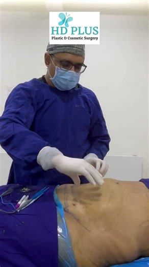 Only 3 Weeks After Tummy Tuck 😳 | Real Result