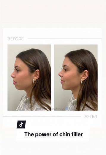 Discover the Power of Chin Filler Enhancements
