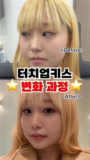 터치업키스 입술필러 변화과정 대공개! 시간이 지날수록 자연스러운 입술 변화 보여드릴게요!