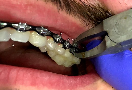 Taking Your Braces Off: The Removal Process Explained