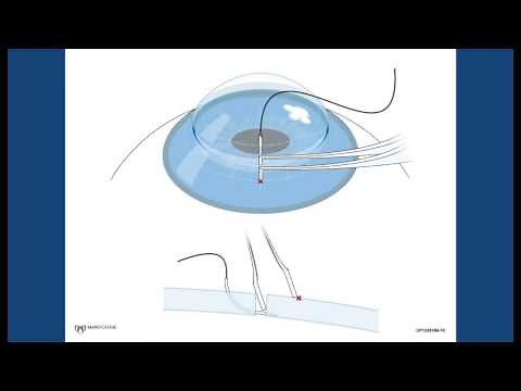 Corneal Suturing, Part 3 - Engaging the Needle Deep in the Host