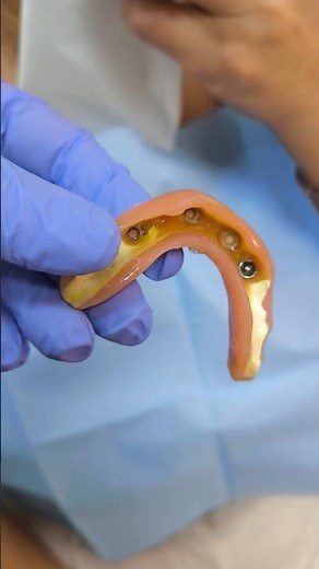 The BIGGEST ADVANTAGE of an overdenture on 4 locator implants