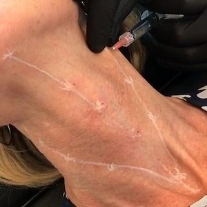 Profhilo neck treatment with BAP technique