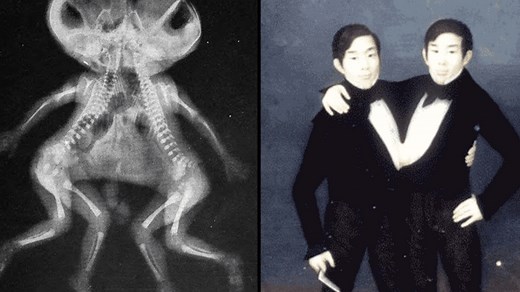 What happens if one conjoined twin dies and the other keeps living