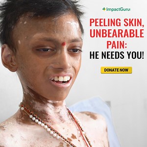1.3M views · 16K reactions | His skin burns in pain as pieces of it fall off from his body. His muscles are eaten up by his own body, reducing him to mere bones. It began with a black blister on Manideep’s lips. His poor parents had no idea that an autoimmune disease called Guillain Barre is attacking Manideep’s nerves. To live, he needs your support. Please donate to end Manideep’s pain. Donate Now: https://tinyurl.com/58buejwr | Impact Guru | Facebook