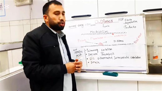 D-dimer Test Description: D-dimer is a blood test used to detect fragments of a blood clot that are being broken down in the body. It helps doctors check for conditions like deep vein thrombosis (DVT) or pulmonary embolism (PE). High levels may indicate the presence of abnormal clotting, while normal levels usually rule out serious clotting diso #foryouシ #fypviralシ #memes #technology #meta #MedicalEducation #HealthAwareness #labtechnician #medicallab #laboratory @topfans | Momand Medical Laborat