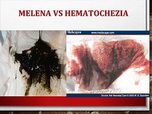 Differences between Melena and Hematochezia
