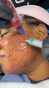 54 reactions | Korean Ac stem cell is the ideal facial therapy for...