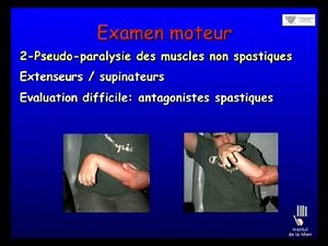 Quelle chirurgie pour le traitement de la spasticité