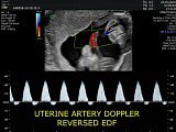 Abnormal Doppler in Case of IUGR • Video • MEDtube.net