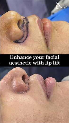 Upper Lip Lift Surgery Before & After: Amazing Lip Enhancement Results!