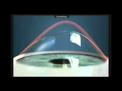 Cirurgia com Crosslinking - Clínica Franca Visão Oftalmologia