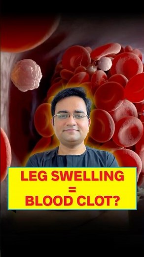 Leg Pain or Swelling? Could it be DVT?