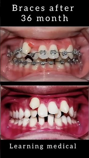 Braises | orthodontics device | teeth alignment