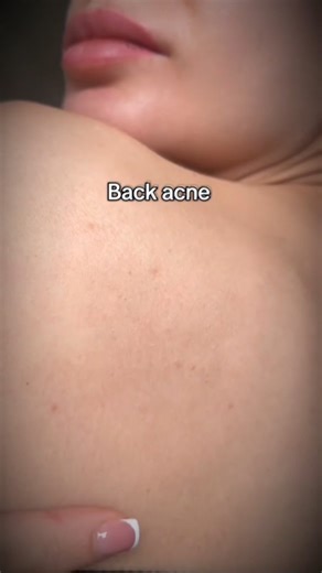 Back Acne? Try This Magical Serum for Clear Skin Fast! #acne #skincare #acnesolutions #acneexpert